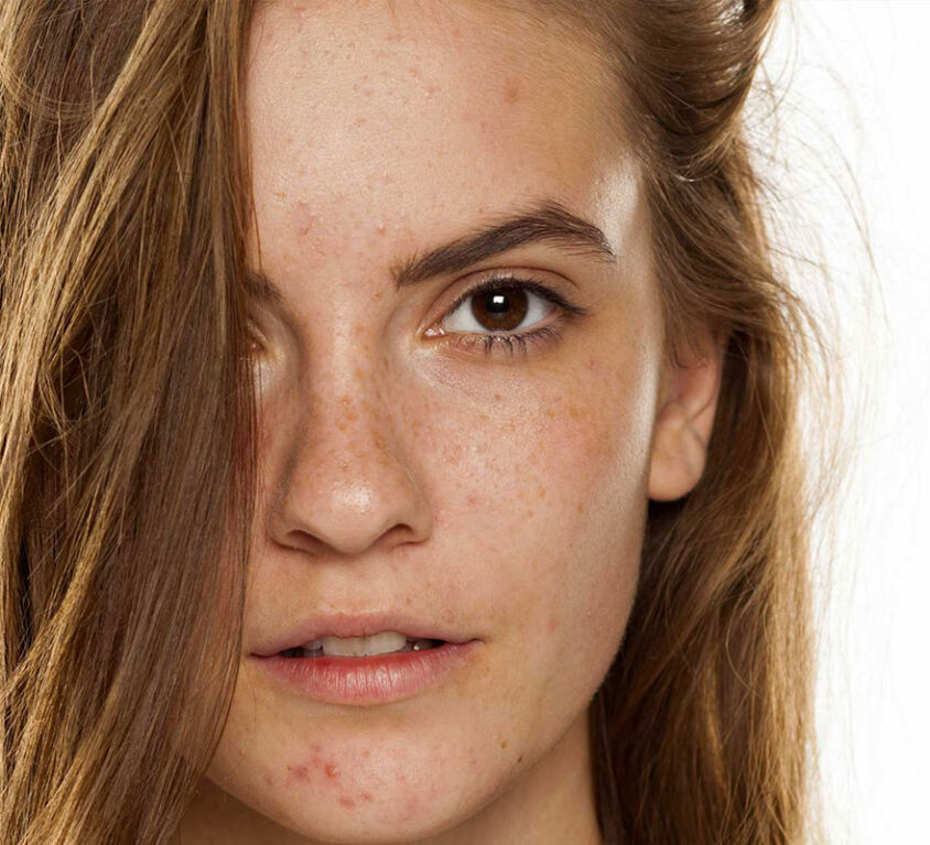 Melasma