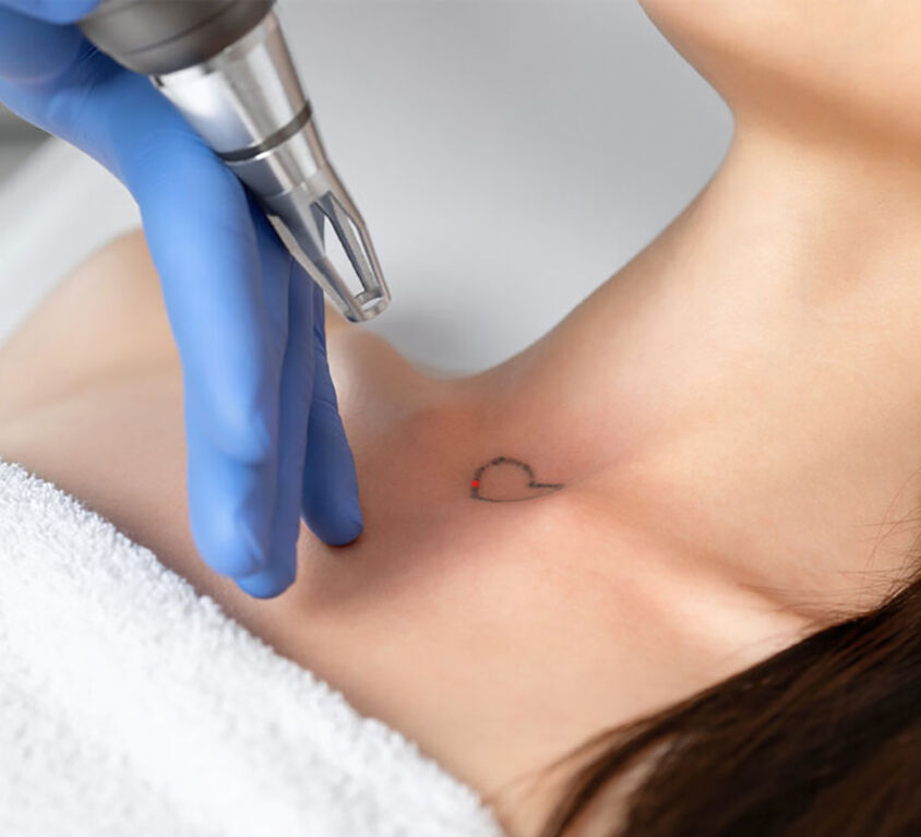 Eliminación de tatuajes