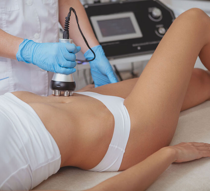 Lipólisis por radiofrecuencia Bodytite