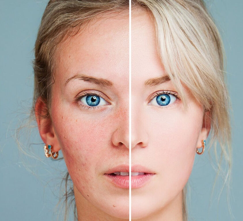 Rosacea